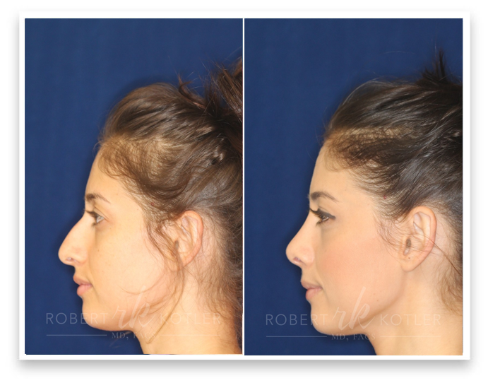 nose job patient before and after