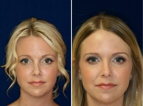 non-surgical rhinoplasty photo in beverly hills