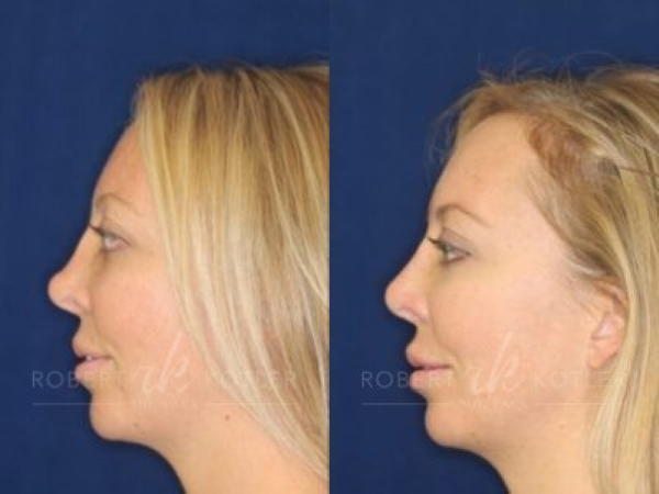 non-surgical rhinoplasty before after photo