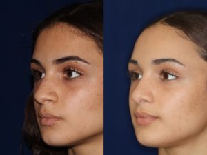 African American Rhinoplasty and African American Nose Job