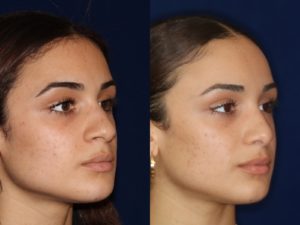 African American Rhinoplasty and African American Nose Job