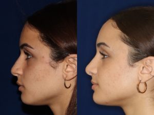 African American Rhinoplasty and African American Nose Job