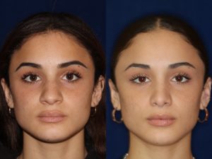 African American Rhinoplasty and African American Nose Job