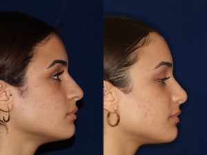 African American Rhinoplasty and African American Nose Job