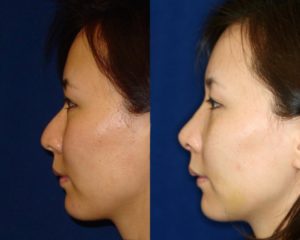 Asian Rhinoplasty and Asian Nose Job