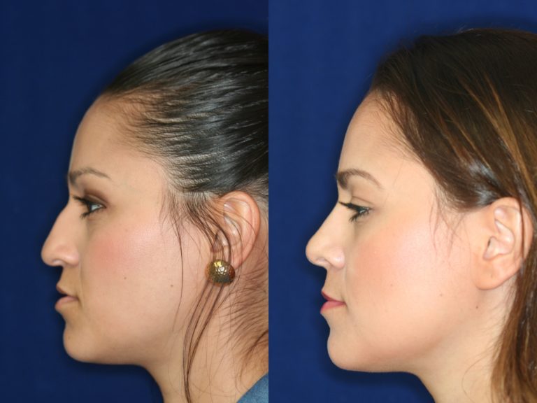 Hispanic Rhinoplasty