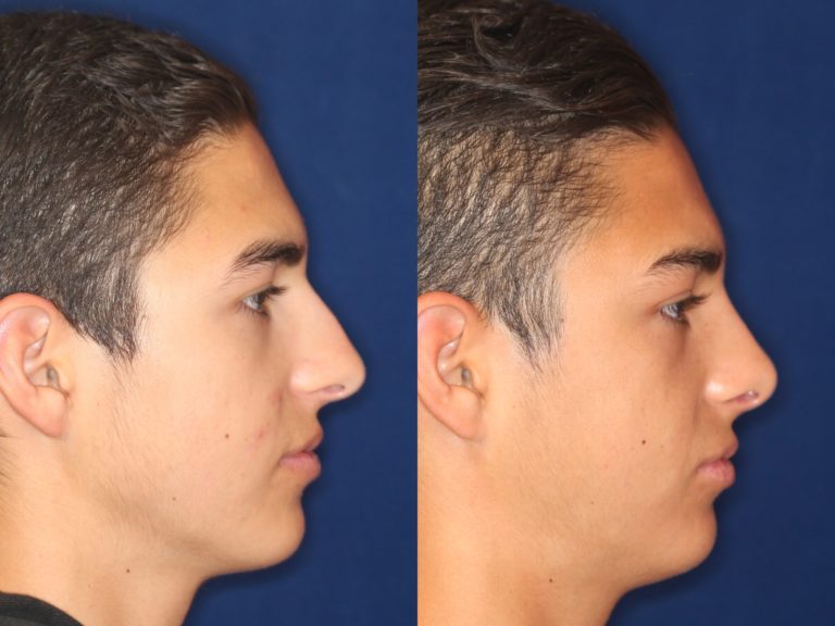 Latino Rhinoplasty