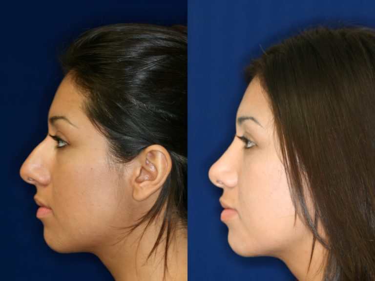 Latino Rhinoplasty