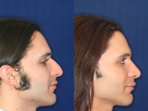 Middle Eastern Rhinoplasty and Middle Eastern Nose Job