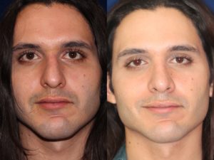 Middle Eastern Rhinoplasty and Middle Eastern Nose Job
