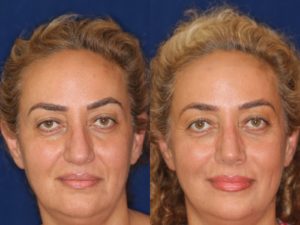 Middle Eastern Rhinoplasty and Middle Eastern Nose Job