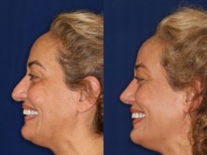 Middle Eastern Rhinoplasty and Middle Eastern Nose Job