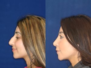 Middle Eastern Rhinoplasty and Middle Eastern Nose Job