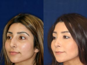 Middle Eastern Rhinoplasty and Middle Eastern Nose Job