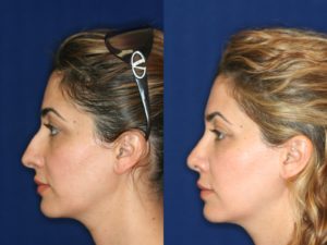 Middle Eastern Rhinoplasty and Middle Eastern Nose Job