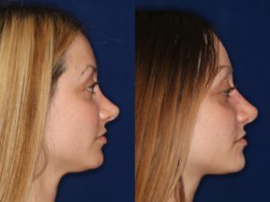 revision non-surgical rhinoplasty