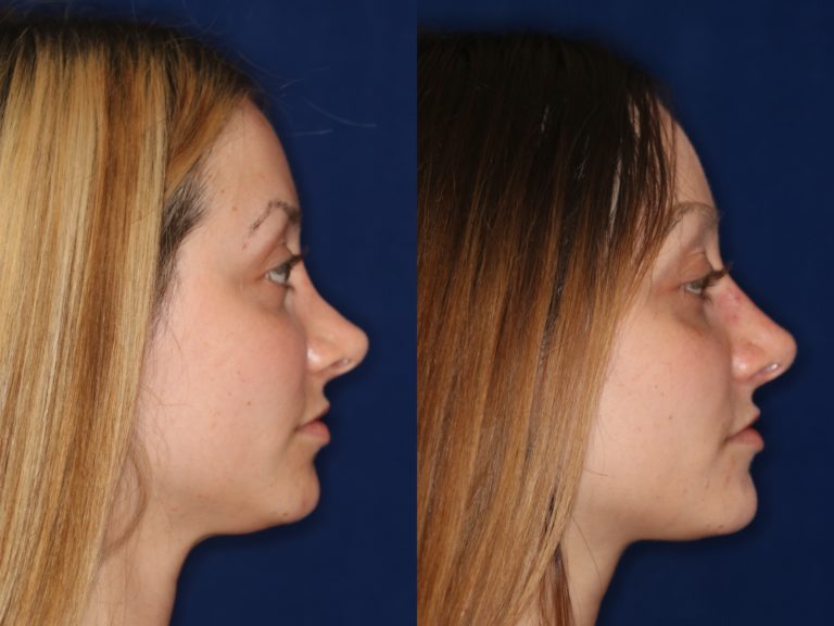non-surgical rhinoplasty photo in beverly hills