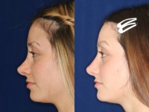 revision non-surgical rhinoplasty