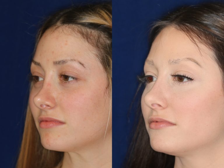 non-surgical nose job photo in beverly hills