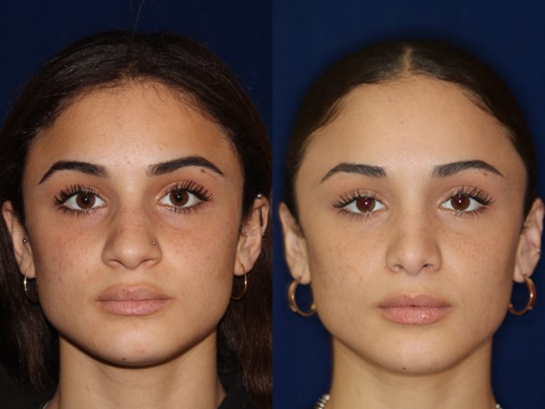 African American Rhinoplasty before and after Nose Job