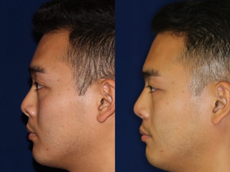 Asian Rhinoplasty before and after nose job
