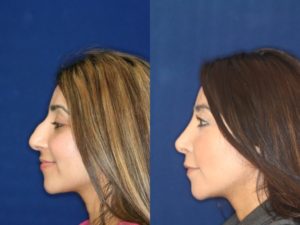Middle Eastern Rhinoplasty before and after nose job