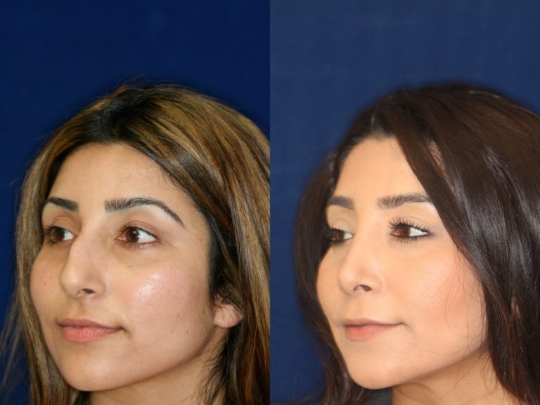 Middle-Eastern-rhinoplasty