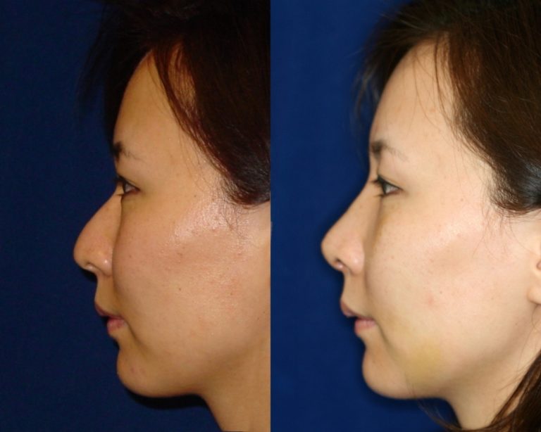 asian-ethnic-rhinoplasty