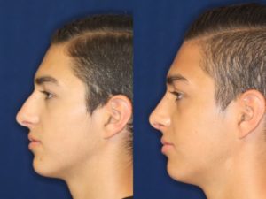 Hispanic Rhinoplasty before and after nose job