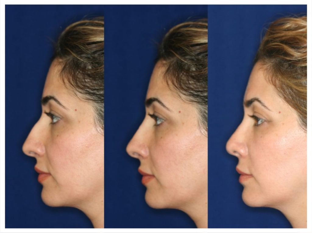 Rhinoplasty Computer Imaging. See your nose before surgery at our in Beverly Hills location