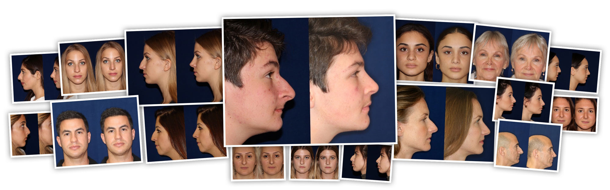 Beverly Hills Rhinoplasty Before and After Photos