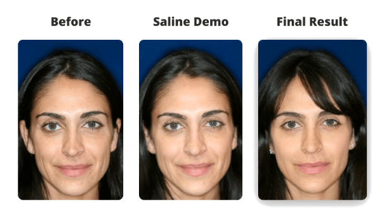 Non-Surgical Rhinoplasty Photos - Liquid Nose Job