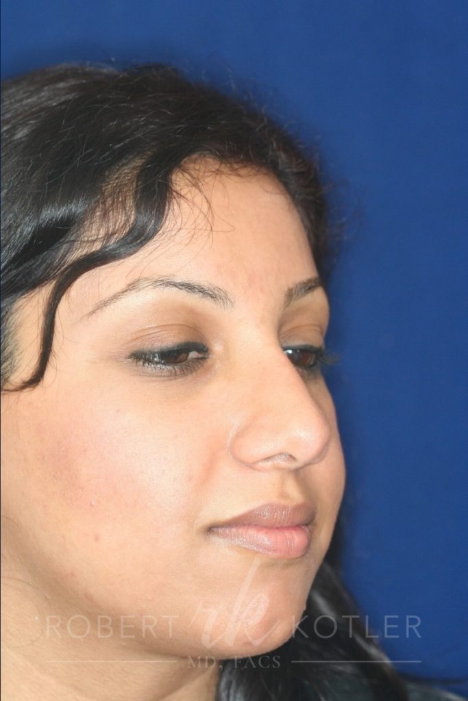 Closed Rhinoplasty - Right Profile - After Pic - Hump removal - Tip refinement - Nose recessed closer to face - Top Rhinoplasty Surgeon