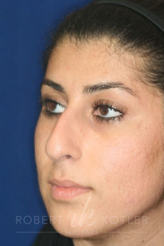 Closed Rhinoplasty - Left Angle Profile - Before Pic - Hump removal - Tip refinement - Nose recessed closer to face - Beverly Hills Rhinoplasty Superspecialist