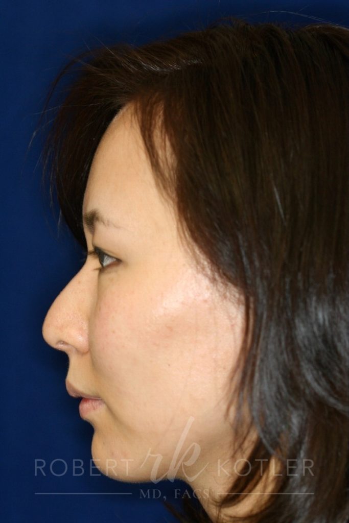 Closed Rhinoplasty - Left Profile - Before Pic - Hump removal - Lowering of bridge - raising of tip - Beverly Hills Rhinoplasty Superspecialist