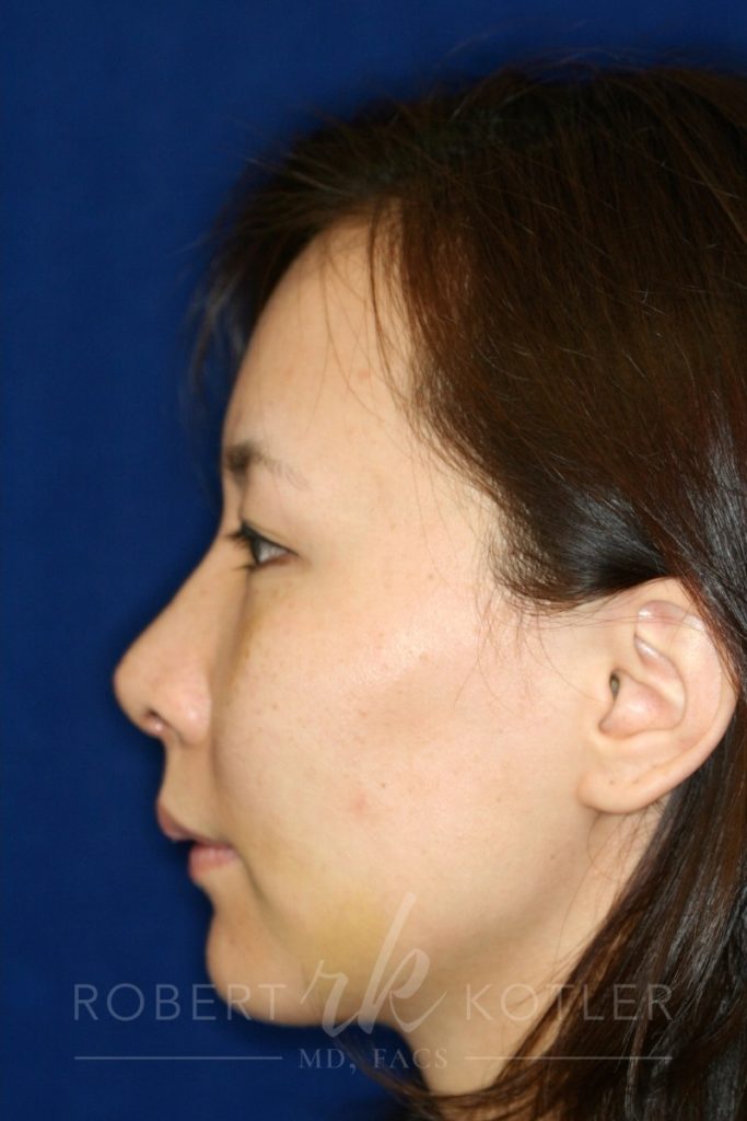 Closed Rhinoplasty - Left Profile - After Pic - Hump removal - Lowering of bridge - raising of tip - Best Rhinoplasty Beverly Hills