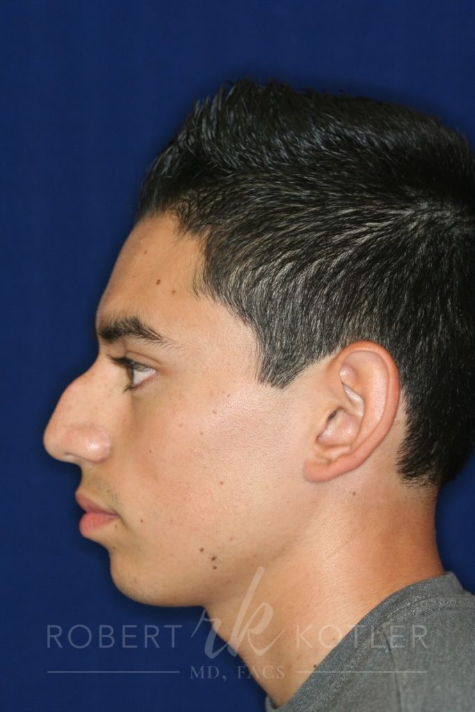 Closed Rhinoplasty - Left Profile - Before Pic - Hump removal - Elevation of nose from the lip - Tip refinement - Best Nose Job Surgeon