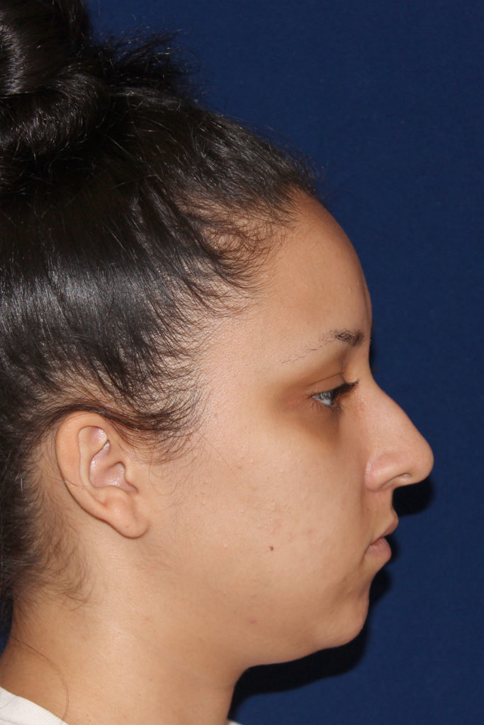 Closed Rhinoplasty - Right Profile - Before Pic - Hump removal - Tip refinement - Elevation from the lip - Beverly Hills Rhinoplasty Superspecialist