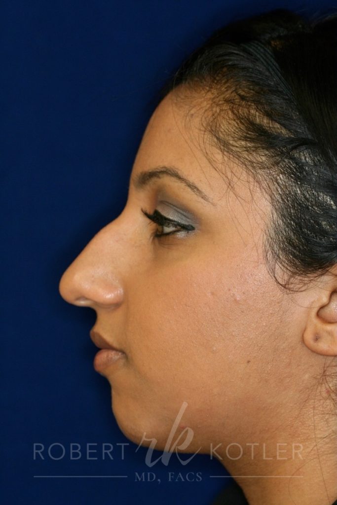 Closed Rhinoplasty - Left Profile - Before Pic - Hump removal - Tip refinement - Nose recessed closer to face - Beverly Hills Rhinoplasty Superspecialist