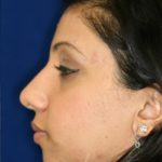 Closed Rhinoplasty - Left Profile - After Pic - Hump removal - Tip refinement - Nose recessed closer to face - Best Rhinoplasty Beverly Hills