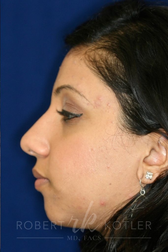 Closed Rhinoplasty - Left Profile - After Pic - Hump removal - Tip refinement - Nose recessed closer to face - Best Rhinoplasty Beverly Hills