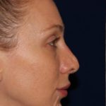 Permanent Non-surgical Revision Rhinoplasty - Right Profile - Before Pic - Permanent filler to restore tip - Thickened skin treated with steroid injections - Nose Job in Beverly Hills