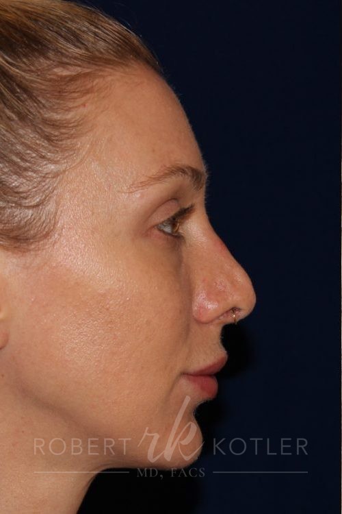 Permanent Non-surgical Revision Rhinoplasty - Right Profile - Before Pic - Permanent filler to restore tip - Thickened skin treated with steroid injections - Nose Job in Beverly Hills