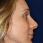 Permanent Non-surgical Revision Rhinoplasty - Right Profile - After Pic - Permanent filler to restore tip - Thickened skin treated with steroid injections - Best Nose Job Surgeon