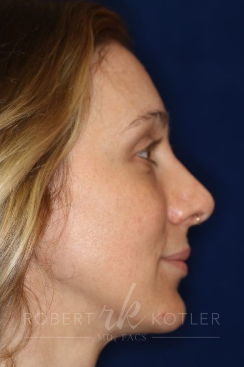 Permanent Non-surgical Revision Rhinoplasty - Right Profile - After Pic - Permanent filler to restore tip - Thickened skin treated with steroid injections - Best Nose Job Surgeon