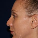 Permanent Non-surgical Revision Rhinoplasty - Left Profile - Before Pic - Permanent filler to restore tip - Thickened skin treated with steroid injections - Top Rhinoplasty Surgeon