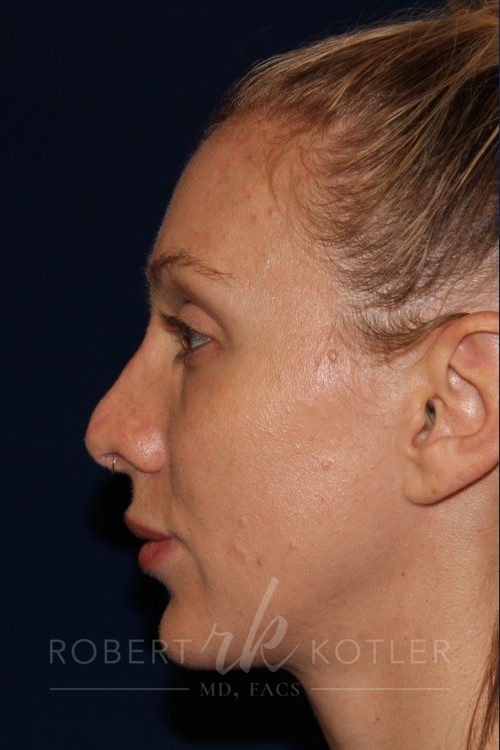 Permanent Non-surgical Revision Rhinoplasty - Left Profile - Before Pic - Permanent filler to restore tip - Thickened skin treated with steroid injections - Top Rhinoplasty Surgeon