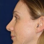 Permanent Non-surgical Revision Rhinoplasty - Left Profile - After Pic - Permanent filler to restore tip - Thickened skin treated with steroid injections - Beverly Hills Rhinoplasty Superspecialist