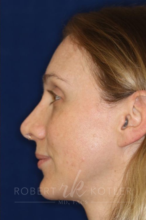 Permanent Non-surgical Revision Rhinoplasty - Left Profile - After Pic - Permanent filler to restore tip - Thickened skin treated with steroid injections - Beverly Hills Rhinoplasty Superspecialist