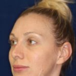 Permanent Non-surgical Revision Rhinoplasty - Left Angle Profile - Before Pic - Permanent filler to restore tip - Thickened skin treated with steroid injections - Best Rhinoplasty Beverly Hills